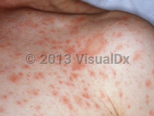 Clinical image of Pityriasis rosea