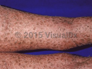 Clinical image of Lamellar ichthyosis - imageId=37020. Click to open in gallery.  caption: 'Diffuse brown ichthyotic scales on the posterior legs.'