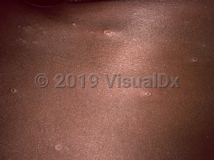 Clinical image of Varicella - imageId=3703202. Click to open in gallery.  caption: 'A close-up of scattered vesicles, some umbilicated.'