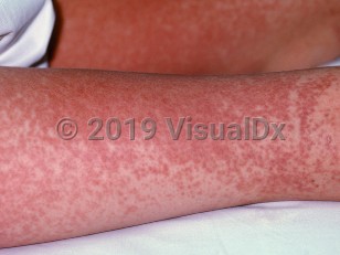 Clinical image of Drug-induced hypersensitivity syndrome - imageId=3727. Click to open in gallery.  caption: 'Widespread erythema and secondary purpuric macules on the leg of a patient with hypersensitivity syndrome from an anticonvulsant.'