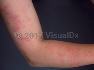 Clinical image of Urticaria