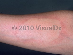 Clinical image of Cold urticaria - imageId=376675. Click to open in gallery.  caption: 'A markedly edematous plaque with surrounding erythema developing after application of an ice cube (ice cube test).'