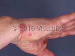 Clinical image of Sponge dermatitis - imageId=3782179. Click to open in gallery.  caption: 'Crusted pink papules and plaques on the hand and wrist.'
