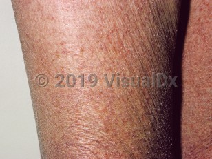 Clinical image of Acquired ichthyosis
