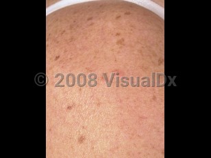 Clinical image of Familial leiomyomatosis cutis et uteri - imageId=3789056. Click to open in gallery.  caption: 'Faint pink papules on the shoulder (leiomyomas). Note the unrelated lentigines secondary to sun damage.'