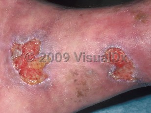 Clinical image of Factitial ulcer - imageId=380793. Click to open in gallery.  caption: 'Granulating ulcers with some overlying slough, and violaceous geographic borders and surrounding erythema at the ankle.'