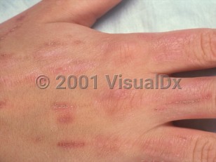 Clinical image of Factitial dermatitis - imageId=383779. Click to open in gallery.  caption: 'Linear scaly plaques on the dorsal hand and fingers.'