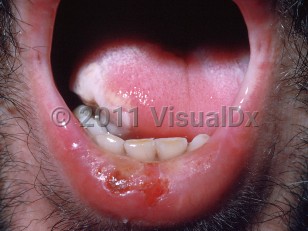 Clinical image of Drug-induced oral ulcer