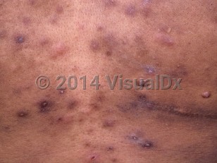 Clinical image of Immunosuppression-associated eosinophilic folliculitis - imageId=388274. Click to open in gallery.  caption: 'A close-up of urticarial and excoriated, pink and brown papules on the chest of a patient with AIDS.'