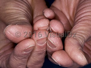Clinical image of Irritant contact dermatitis - imageId=3921662. Click to open in gallery.  caption: 'Dry skin and scaling of the fingertips.'