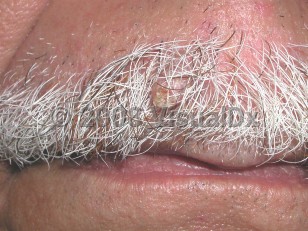 Clinical image of Trichilemmoma - imageId=3922332. Click to open in gallery.  caption: 'An elongated pink papule with a distal keratotic surface on the upper cutaneous lip.'