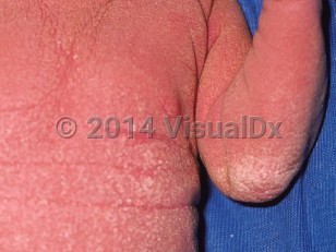 Clinical image of KID syndrome - imageId=39433. Click to open in gallery.  caption: 'Diffuse scaling and hyperkeratosis and background erythema on the trunk and arm.'