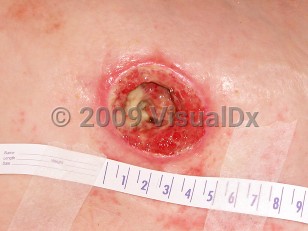 Clinical image of Pressure injury - imageId=3969344. Click to open in gallery.  caption: 'A close-up of a stage 4 pressure injury showing a deep crateriform ulcer with overlying slough.'
