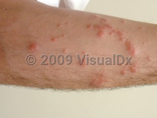 Clinical image of Sea anemone sting - imageId=3971527. Click to open in gallery.  caption: 'Numerous erythematous and markedly edematous papules, some in linear arrays, on the forearm.'
