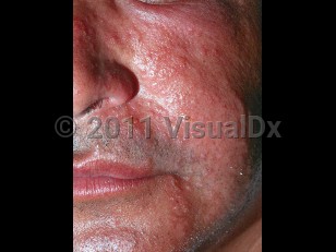 Clinical image of Sea cucumber skin irritation - imageId=3971683. Click to open in gallery.  caption: 'Widespread erythematous and edematous papules and plaques with some crusting on the face.'