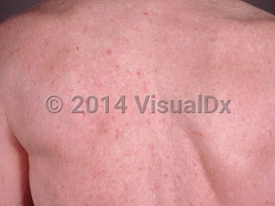 Clinical image of Transient acantholytic dermatosis - imageId=398692. Click to open in gallery.  caption: 'Scattered light pink papules on the upper back.'
