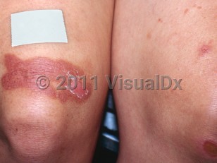 Clinical image of Hogweed dermatitis - imageId=3992956. Click to open in gallery.  caption: 'A brownish and maroon, scaly, patterned plaque with peeling scale on the right lower thigh, a crusted ulcer on the left knee, and a small, crusted, pink plaque on the left thigh.'
