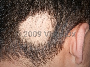 Clinical image of Alopecia areata