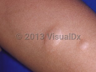 Clinical image of Anetoderma - imageId=40092. Click to open in gallery.  caption: 'Patulous, slightly hypopigmented nodules that were soft to the touch on the forearm.'