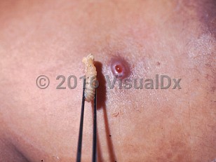 Clinical image of Myiasis