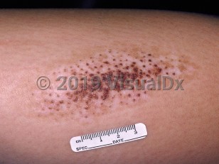 Clinical image of Speckled lentiginous nevus - imageId=40236. Click to open in gallery.  caption: 'A close-up of a pink and light brown patch with numerous dark brown macules and papules within it.'