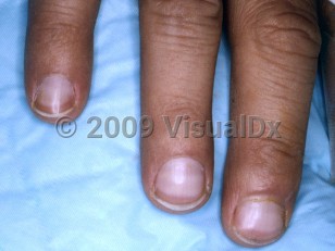Clinical image of Terry nails
