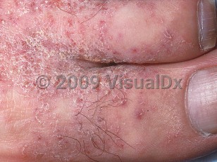 Clinical image of Crusted scabies