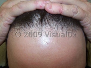Clinical image of Frontal fibrosing alopecia