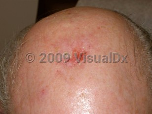 Clinical image of Erosive pustular dermatosis - imageId=4056502. Click to open in gallery.  caption: 'A crusted erosion with a surrounding faint pink scar on the central scalp. Note also the single pustule on the anterior scalp.'