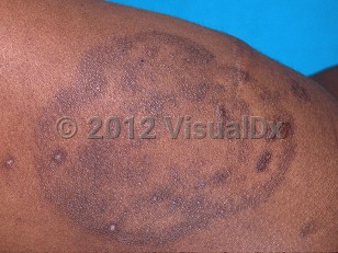 Clinical image of Tinea corporis - imageId=406479. Click to open in gallery.  caption: 'Post-inflammatory annular hyperpigmentation at site of treated tinea on an extremity.'
