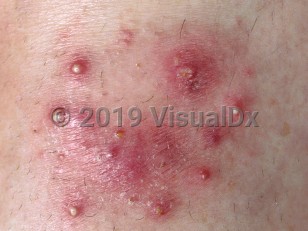 Clinical image of Majocchi granuloma - imageId=407231. Click to open in gallery.  caption: 'A close-up of follicular-centered erythematous papules and pustules in an arcuate arrangement.'