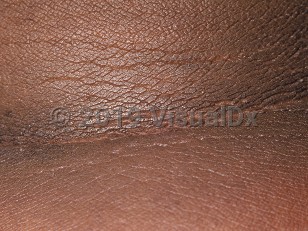 Clinical image of Acanthosis nigricans - imageId=40959. Click to open in gallery.  caption: 'Acanthotic, thickened, ridged, and hyperpigmented plaques on the posterior neck.'