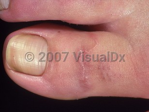 Clinical image of Cutaneous larva migrans - imageId=410980. Click to open in gallery.  caption: 'A thread-like, curvilinear plaque and a couple of nearby violaceous plaques on the dorsal toe.'