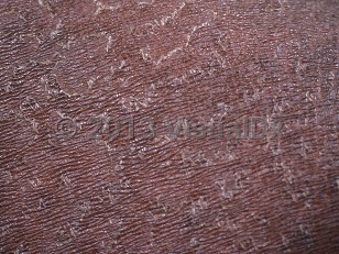 Clinical image of Tinea imbricata - imageId=412232. Click to open in gallery.  caption: 'A close-up of patterned peeling scales.'