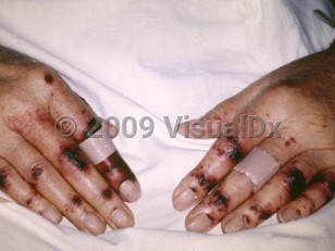 Clinical image of Thrombotic thrombocytopenic purpura - imageId=4124410. Click to open in gallery.  caption: 'Purpuric papules and plaques with overlying hemorrhagic crusting on the fingers and hands.'