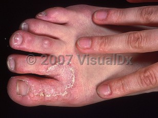 Clinical image of Tinea pedis - imageId=413148. Click to open in gallery.  caption: 'A vesiculated plaque with arcuate scale on the dorsal toes and forefoot. Note also the tiny vesicles on the lateral and dorsal fingers (id reaction).'