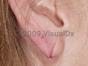 Clinical image of Torn earlobe