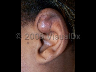 Clinical image of Pseudocyst of auricle - imageId=4152931. Click to open in gallery.  caption: 'A reddish bosselated nodule of the ear.'