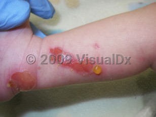 Clinical image of Transient bullous dermolysis of the newborn - imageId=4155804. Click to open in gallery. 