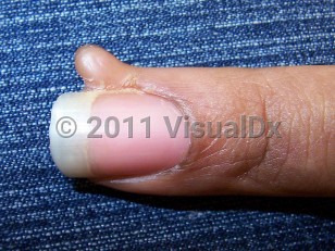 Clinical image of Acquired digital fibrokeratoma - imageId=4157375. Click to open in gallery.  caption: 'Smooth, flesh-colored, pedunculated papule on the lateral nail fold of the digit. Minimal onycholysis is present.'