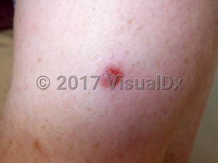 Clinical image of Amelanotic melanoma - imageId=4158614. Click to open in gallery.  caption: 'An amelanotic melanoma showing a pink eroded papule on the arm.'