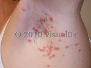 Clinical image of Guttate psoriasis