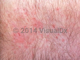 Clinical image of Pruritus of senescence - imageId=417077. Click to open in gallery.  caption: 'Cracked, scaly, erythematous papules and plaques (eczema) occuring secondary to xerosis.'