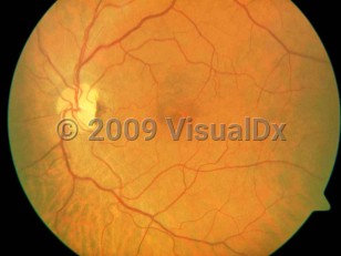 Clinical image of Central retinal artery occlusion - imageId=4174771. Click to open in gallery. 
