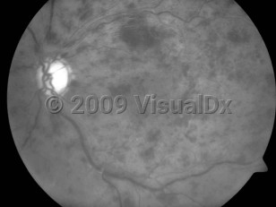 Clinical image of Central retinal vein occlusion