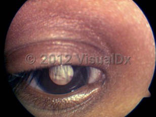 Clinical image of Retinoblastoma - imageId=4176090. Click to open in gallery.  caption: 'Leukocoria.'