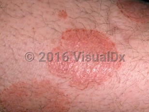 Clinical image of Large plaque parapsoriasis - imageId=41827. Click to open in gallery.  caption: 'A close-up of sharply demarcated, scaly, erythematous plaques.'