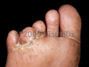 Clinical image of Mixed toe web infection - imageId=4195633. Click to open in gallery.  caption: 'Macerated scale in the third and fourth webspaces that extends to the base of the fourth toe, with surrounding hyperkeratotic scale.'