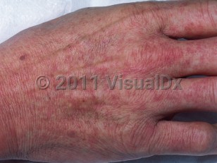 Clinical image of Mononucleosis - imageId=419578. Click to open in gallery.  caption: 'Diffuse deeply erythematous patches and thin plaques on the dorsal hand and fingers.'