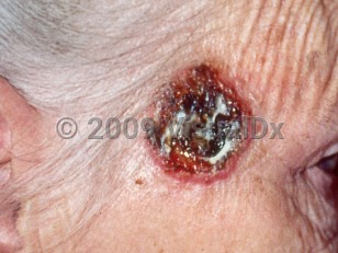 Clinical image of Atypical fibroxanthoma